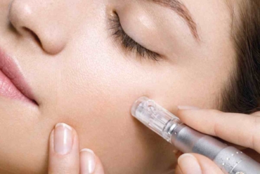 microneedling