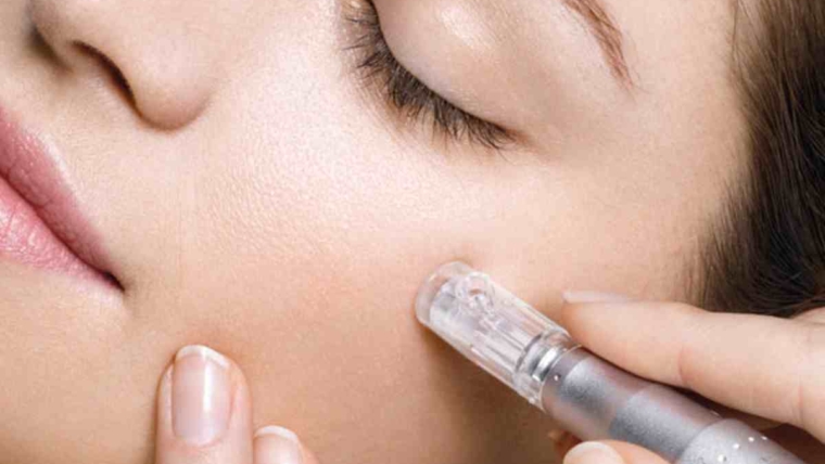 microneedling