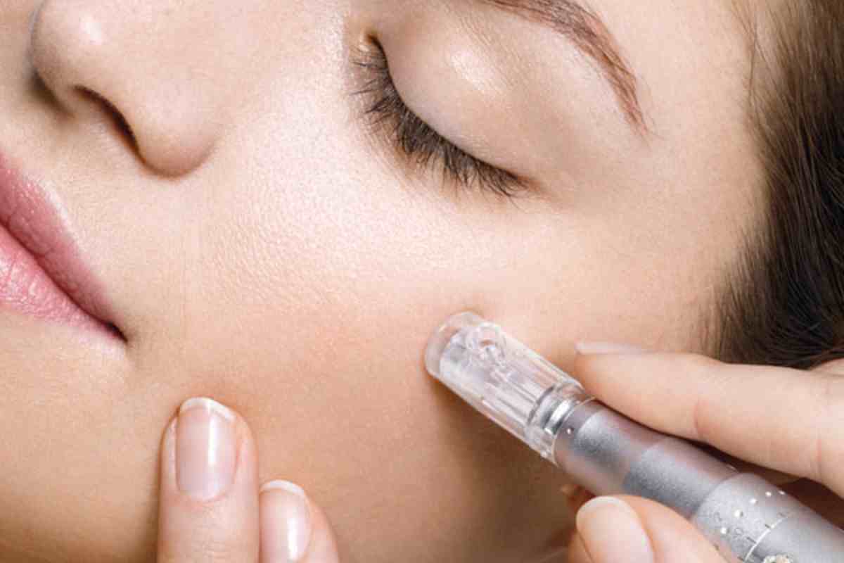 microneedling