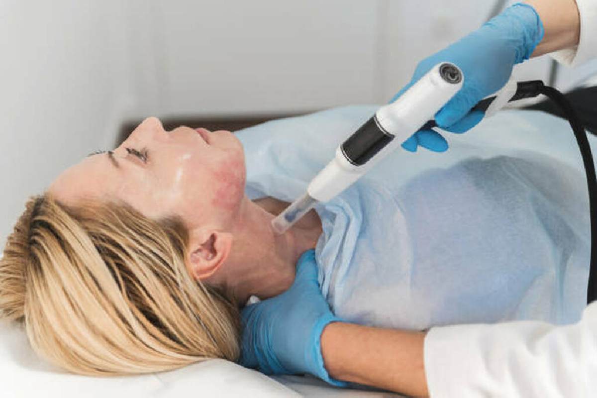 cynosure elite+ treatment