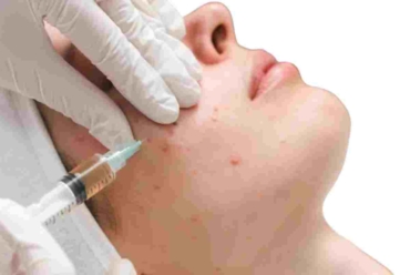 acne removal care