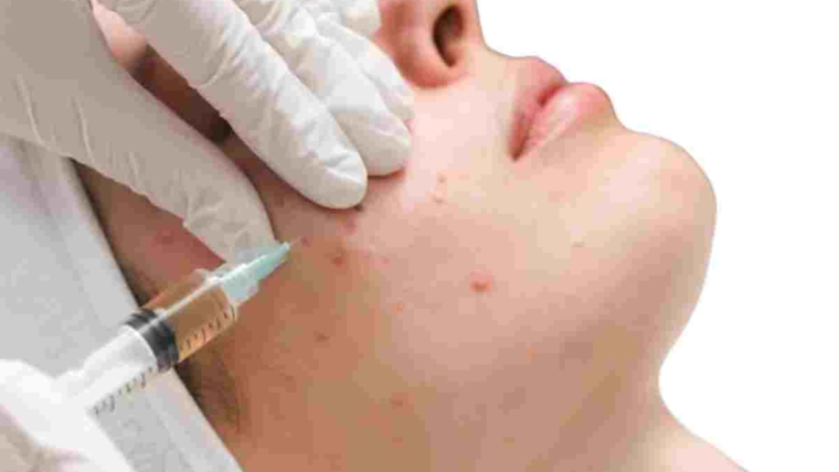 acne removal care