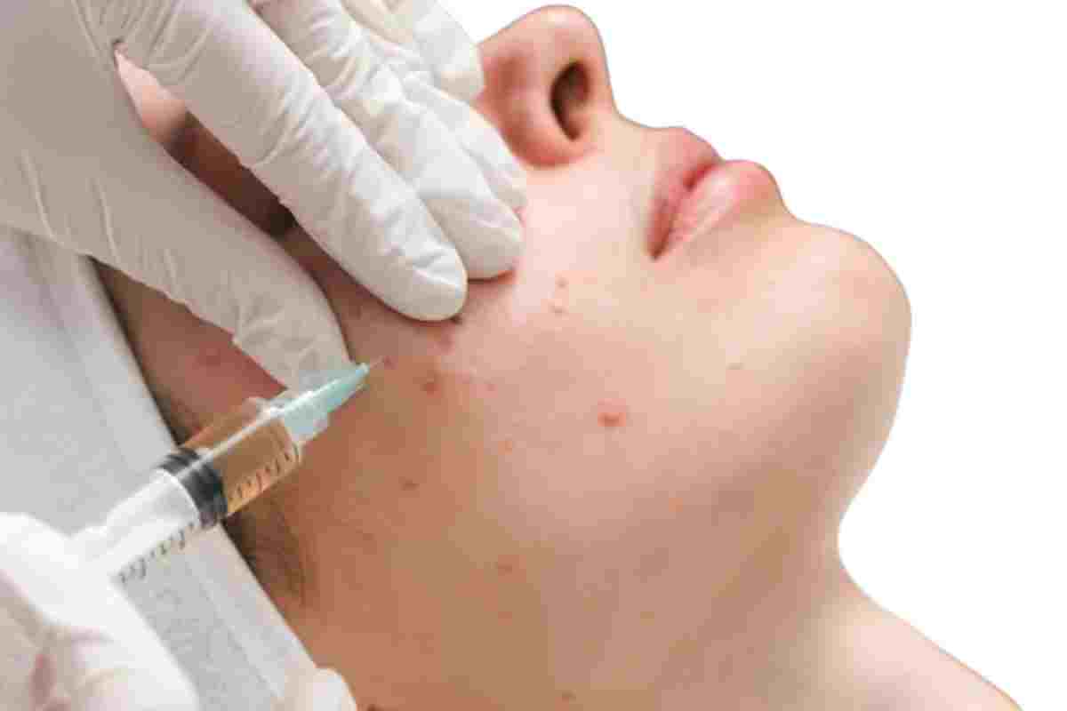 acne removal care