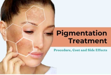 laser treatment for pigmentation