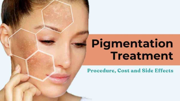 laser treatment for pigmentation